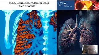 Miniature : LE CANCER DU POUMON EN 2023 : ACTUALITÉS ET PERSPECTIVES