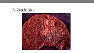 Miniature : Anapath - 3ème cours :Troubles du métabolisme des  pigments
