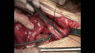 Miniature : REDUCTION D’UNE URETEROILEOPLASTIE
