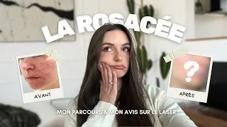 Miniature : J’ai testé le laser pour ma rosacée (avant / après)