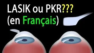 Miniature : LASIK ou PKR? Comparaison des procédures, animation
