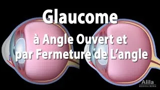 Miniature : Pathologie du Glaucome, Animation