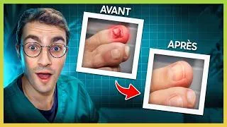Miniature : Il s’est cassé l’ongle… Voici comment un Podologue le soigne