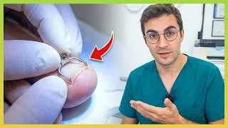 Miniature : REDRESSER un ongle incarné, c'est possible ?