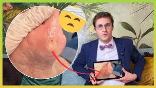 Miniature : Soigner un ÉNORME cor sous un Hallux valgus : Que fait-il ici?!