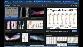 Miniature : Application CLINIQUE du système SQUELETTIQUE