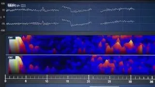 Miniature : Le neurofeedback pour les hallucinations sonores sur Arte
