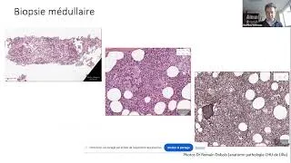 Miniature : Webinaire AIH : Myélofibrose