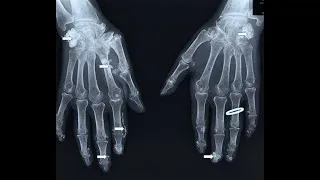Miniature : Webconférence : Les calcifications de la sclérodermie : peut-on les éviter ? Comment les traiter ?