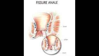 Miniature : COMMENT SOIGNER UNE FISSURE ANALE SODOM..INFECTION...