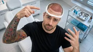 Miniature : Greffe de Cheveux en Turquie Partie 1 : Accueil et Examens au Sein de la Clinique