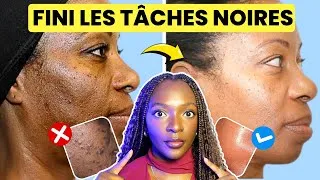 Miniature : Comment ÉLIMINER les tâches noires sur le visage - GUIDE COMPLET 2025