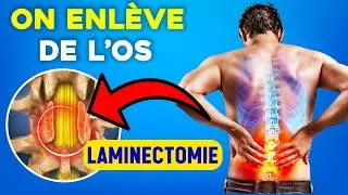Miniature : LAMINECTOMIE :  Pourquoi on enlève les “LAMES” d’une vertèbre ?