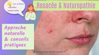 Miniature : Rosacée et naturopathie: Approche naturelle et conseils pratiques