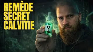 Miniature : Je TEST une solution MIRACLE contre la CALVITIE ( ET ÇA MARCHE! )