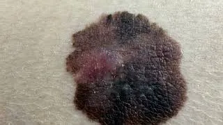 Miniature : Le Mélanome : les cellules cancéreuses