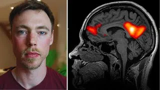 Miniature : Comment j’ai guéri l'ANXIETE, LA RUMINATION et le BURNOUT : tu dois activer CETTE partie du cerveau