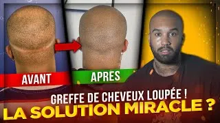 Miniature : Comment la TRICOPIGMENTATION a sauvé ma GREFFE de cheveux LOUPÉE ?