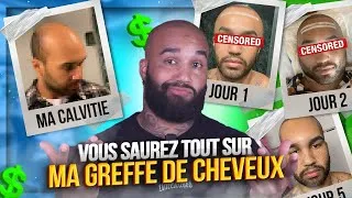 Miniature : ce que PERSONNE ne vous dira sur LA GREFFE DE CHEVEUX ! ( vidéo non sponso )