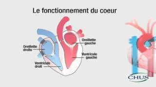 Miniature : Chirurgie cardiaque | Introduction