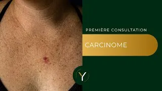 Miniature : Carcinome