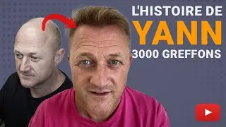 Miniature : Greffe de cheveux avec 3000 greffons : Une transformation étonnante