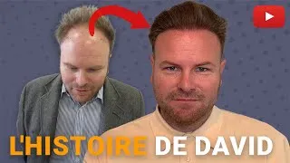 Miniature : 5000+ greffes ∣ 15240 cheveux ∣ Le succès de la greffe de cheveux de David