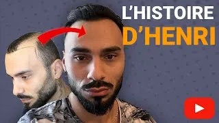 Miniature : Transformation de la ligne frontale: une aventure avec une greffe de cheveux de 2000 greffons