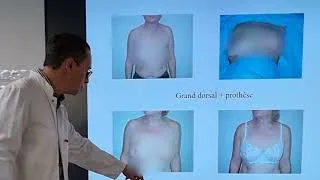 Miniature : Les différentes techniques de reconstruction différée après mastectomie.