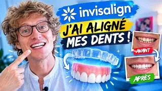 Miniature : J'ai ALIGNE mes DENTS suite à une Parodenthie (traitement Invisalign) Paris