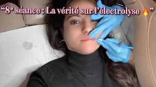 Miniature : FINI le laser pour le visage – L’électrolyse gagne ! ( 8ème séances )