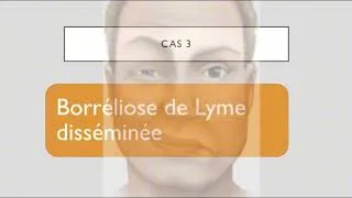 Miniature : Comment rassurer les patients devant une borréliose de Lyme ?