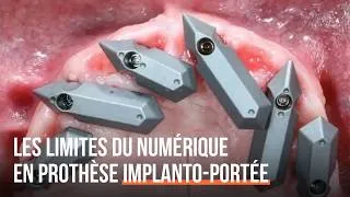 Miniature : Les limites du numérique en prothèse implanto-portée complète fixe - Dr Mai Lan Tran