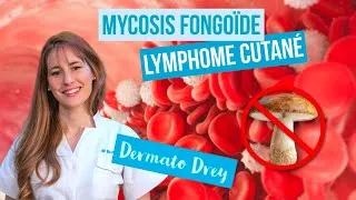 Miniature : Mycosis fongoïde : un lymphome dans la peau, qu'est ce que c'est ? Les réponses par @DermatoDrey
