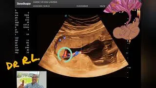 Miniature : ✅️ Analyse 🤔 du placenta 🫄et de l’insertion du cordon ombilical 👉 😲⚠️