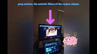Miniature : Petit aperçu de l'analyse du cerveau fœtal lors de l'écho morphologique du T2 de grossesse