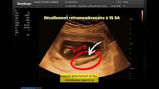 Miniature : 🚨Pertes de sang et petites contractions😟 à 15 SA de grossesse , mon diagnostic 🤔