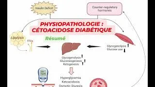 Miniature : Physiopathologie de la Cétoacidose diabétique (Résumé)