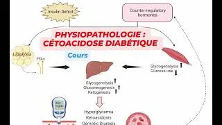 Miniature : Physiopathologie de la Cétoacidose Diabétique