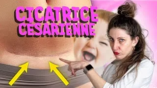 Miniature : CICATRICE ABDO de césarienne, la cata ! 👼