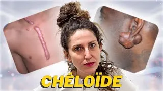 Miniature : Cicatrice CHÉLOÏDE que faire ??!