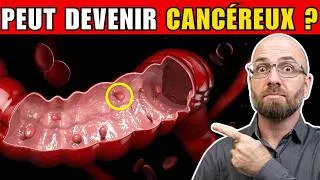 Miniature : Les POLYPES DU CÔLON peuvent-ils se transformer en CANCER ? Voici quoi manger pour réduire le risque
