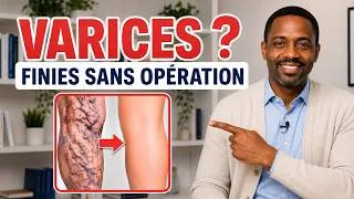 Miniature : Les varices disparaissent sans chirurgie : le plan étape par étape