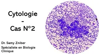 Miniature : Cytologie - Lymphome de BURKITT 🔬