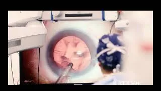 Miniature : Chirurgie 3D de la Cataracte