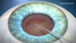 Miniature : Principes de la chirurgie de la cataracte