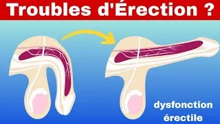 Miniature : Dysfonction Érectile Après 40 Ans : Que Faire ?