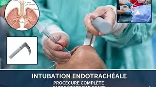 Miniature : Intubation endotrachéale - Guide pratique