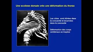 Miniature : Orthopedie Pediatrique - Scolioses [FMPC]