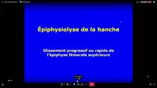 Miniature : Orthopedie Pediatrique - Epyphisolyse de la Hanche [FMPC]
